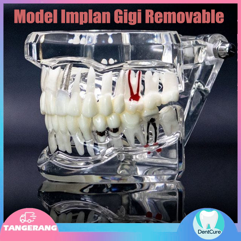 Model study gigi edukasi transparan studi implant phantom crown karies bridge bening impaksi model g