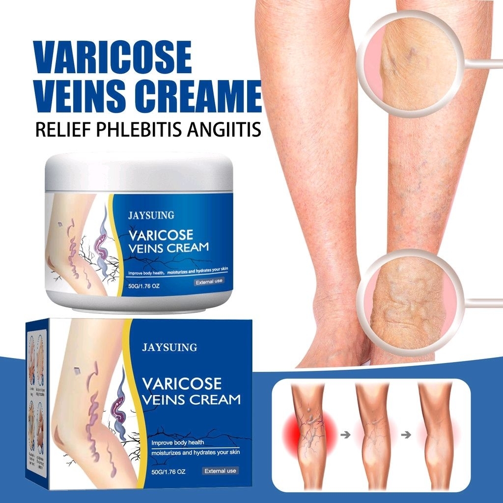Varicose Veins Cream 50g Salep Varises Kaki Menghilangkan Varises Kaki Soothing Acid
