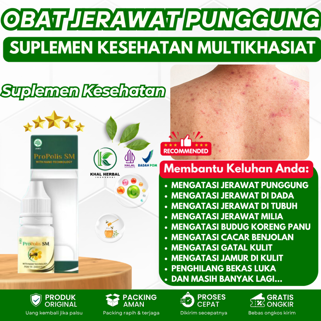 Obat Jerawat di punggung, Penghilang Jerawat di Punggung, Obat Biang Keringat di punggung, Bintik di