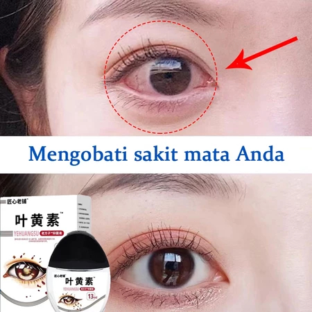 Tetes mata tetes mata katarak mata kering mata perih kemerahan mata lelah miopia katarak berlemak pe