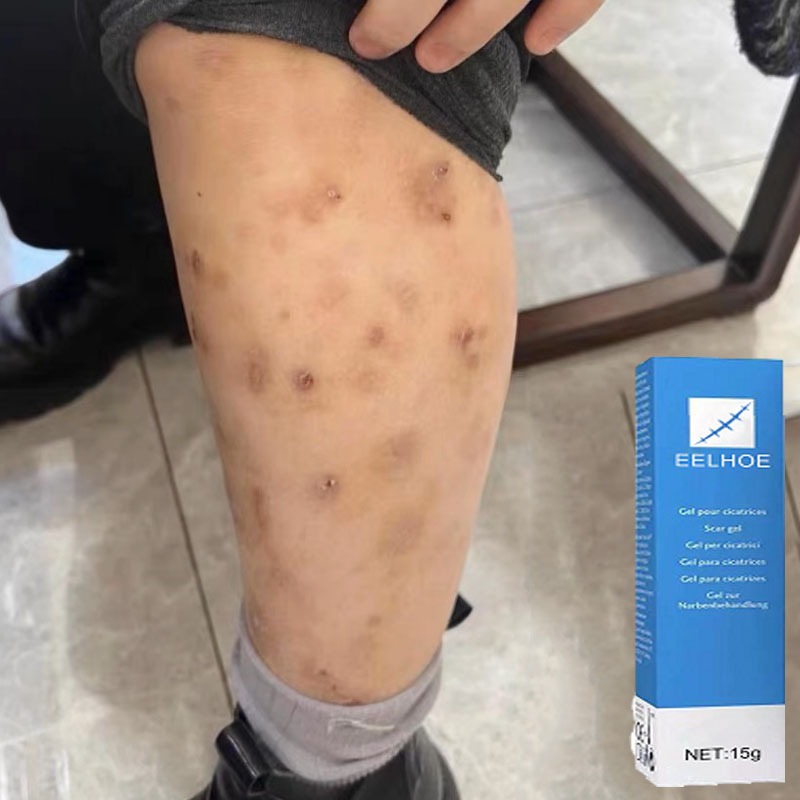 Obat penghilang bekas luka Salep penghilang bekas luka Penghilang bekas luka hitam Penghilang bekas 