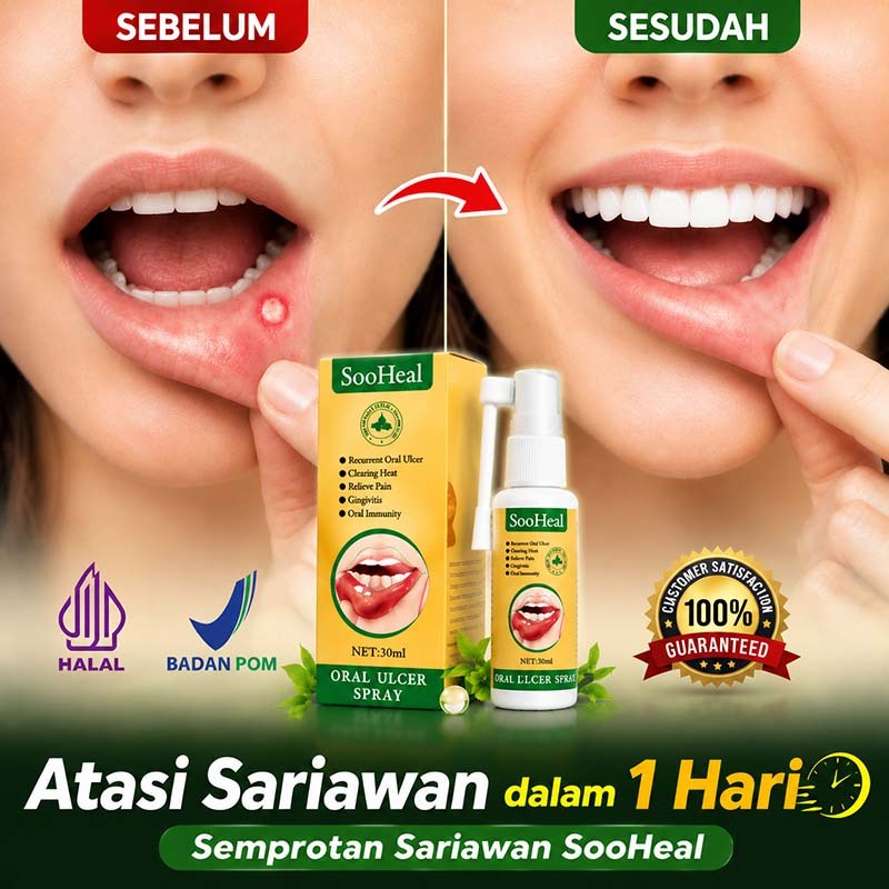 [SooHeal]Obat Sariawan Spray Semprotan Sariawan Mulut 30ml obat sariawan cepat sembuh luka bibir sar