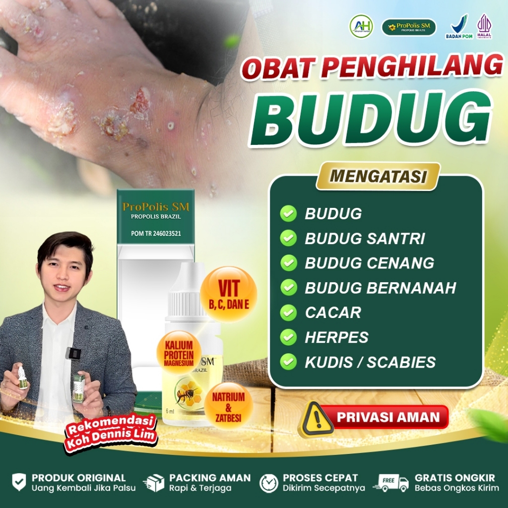 Obat Cacar Air Anak Dewasa Penghilang Bekas Cacar Cacar Api Kulit Bintik Berair Herpes - Propolis SM