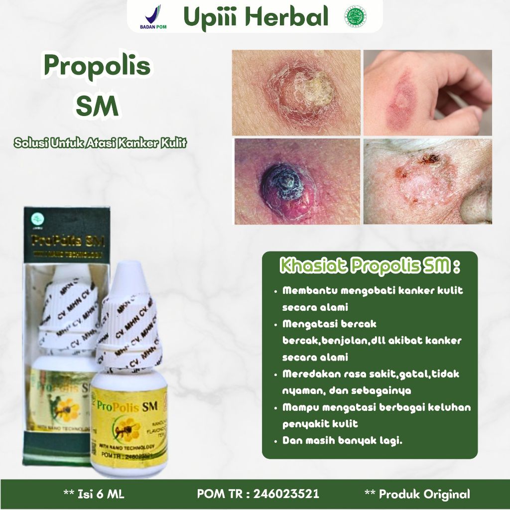 OBAT HERBAL KANKER KULIT, OBAT KANKER KULIT, KANKER KULIT MELANOMA, OBAT PEMBANTU PENGHILANG KANKER 