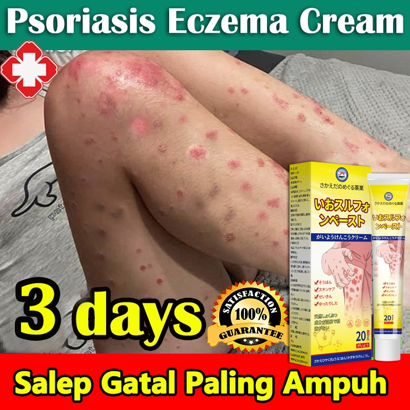 Salep Gatal Paling Ampuh Obat Gatal Selangkangan Obat Eksim Obat Kurap 20g Ampuh Obat Gatal Kulit Sa
