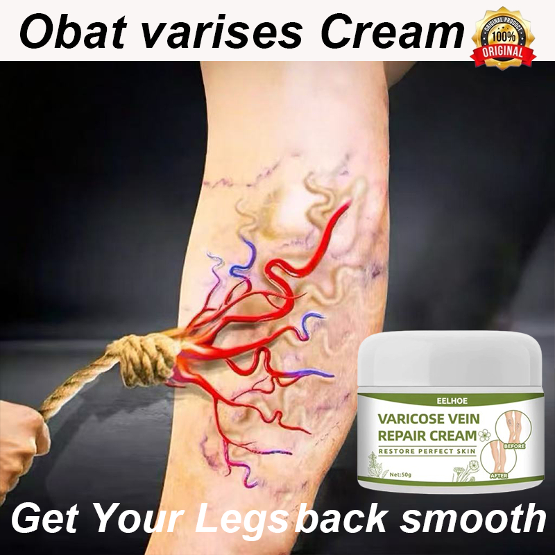 Obat varises Cream varises paling ampuh original Varises kaki Treatment Varicose veins cream Angiiti