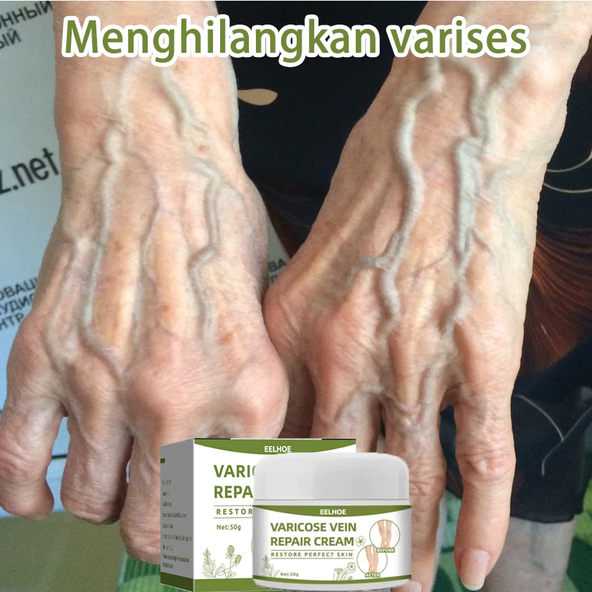 Obat Varises Obat Varises Paling Ampuh Menghilangkan varises Varicose Veins Treatment Urat Menonjol 