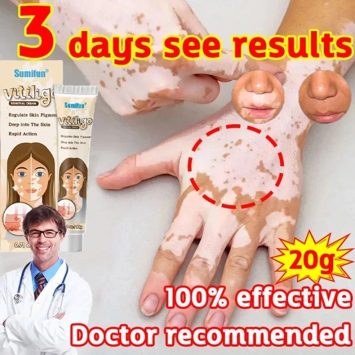 salep vitiligo ori 100% vitiligo salep kulit obat vitiligo Formula herbal penyakit kulit putih lepra