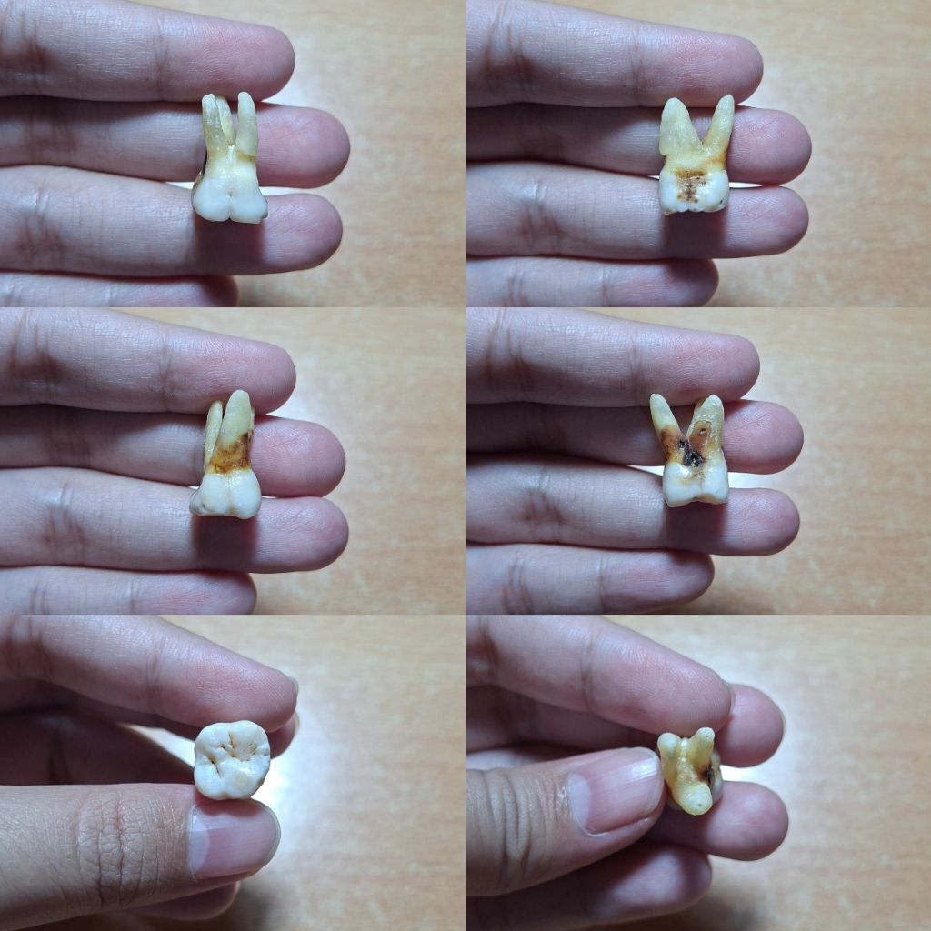 Gigi Molar 16