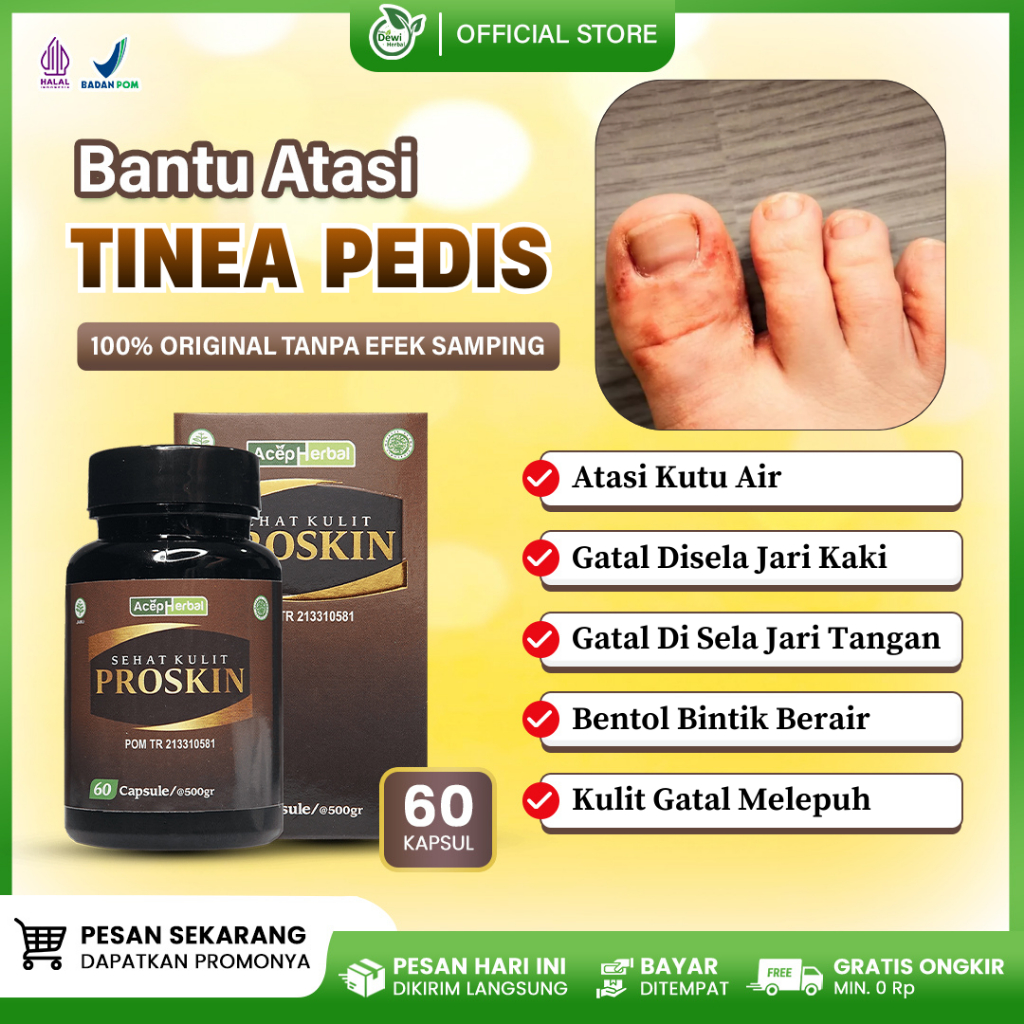 Obat Kutu Air (Tinea Pedis) - Lepuhan Gatal Di Sela Jari Tangan Kaki - Bentol Berisi Cairan Bening -