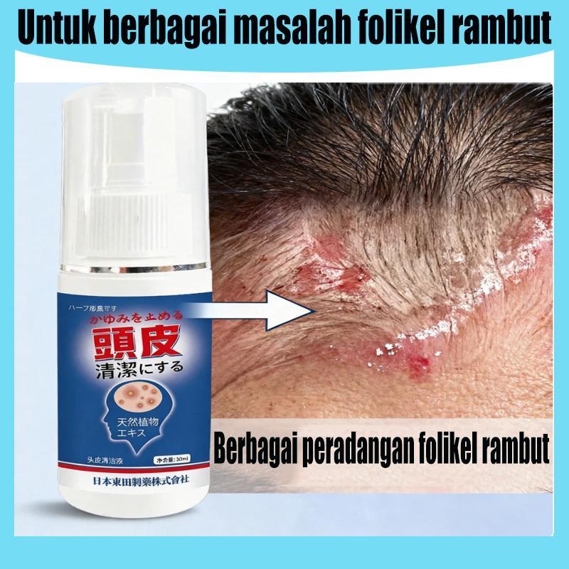 Semprotan Kulit Kepala Obat Ketombe Membandel Obat Ketombe Berkerak Dermatitis seboroik Obat jamur k