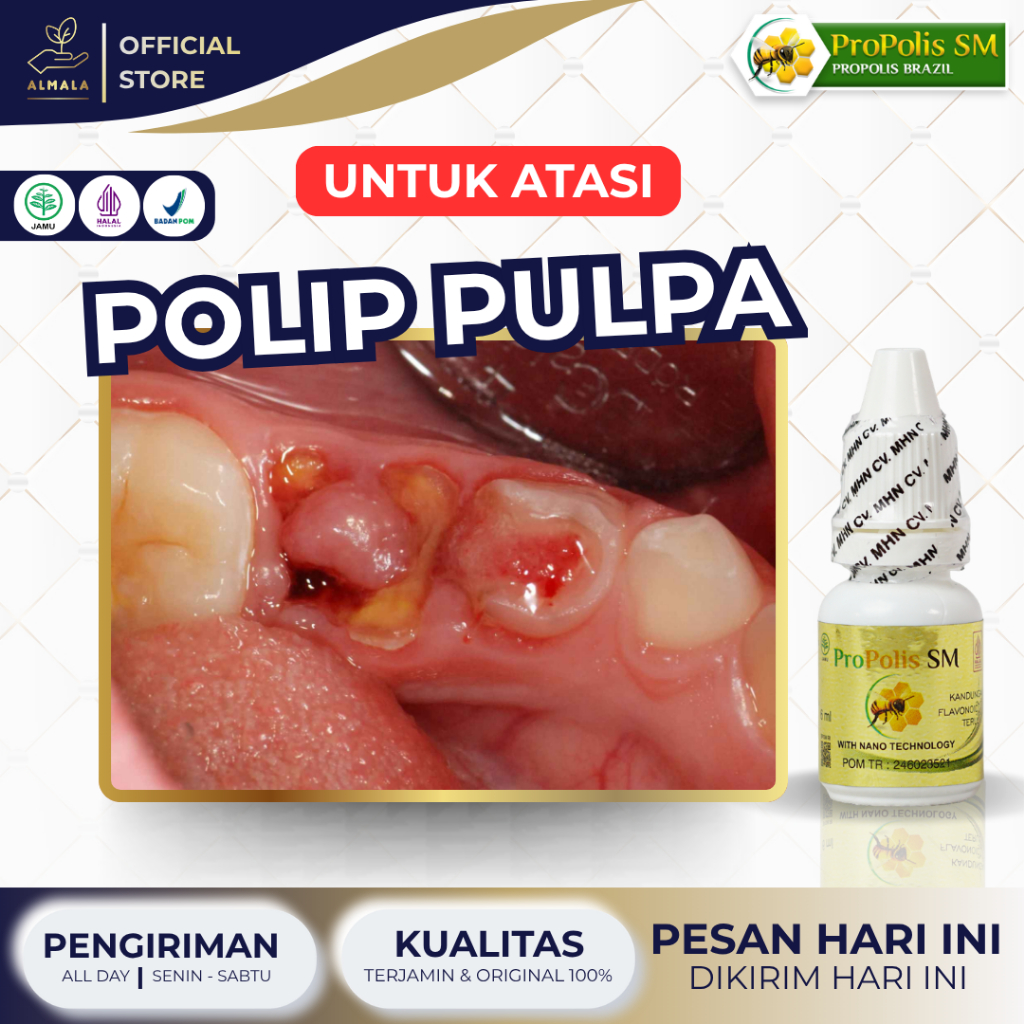 Obat Polip Pulpa, Obat Polip Gigi Di Gusi, Obat Polip Gigi, Obat Polip Gusi, Obat Gusi Bengkak, Obat