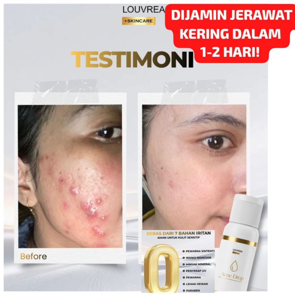 TERMURAH Acne drop obat jerawat Louvrea skincare.