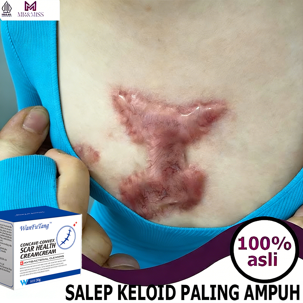 krim hilangkan bekas luka Penghilang keloid scar removal cream Bekas lama salep keloid stretch mark 