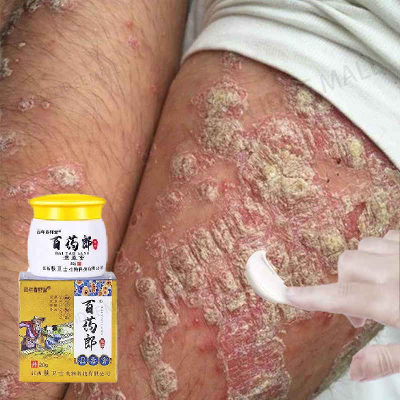 Salep Eksim Kering dan Gatal Salep Gatal China Paling Ampuh Obat Gatal Selangkangan Salep Bayi Untuk