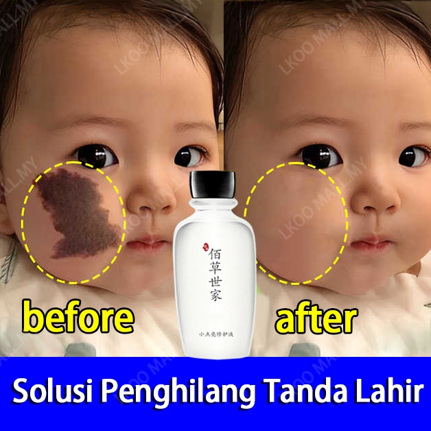 Penghilang Tanda Lahir 100g Obat Penghilang Tanda Lahir Penghilang tanda lahir coklat Coklat Hitam M