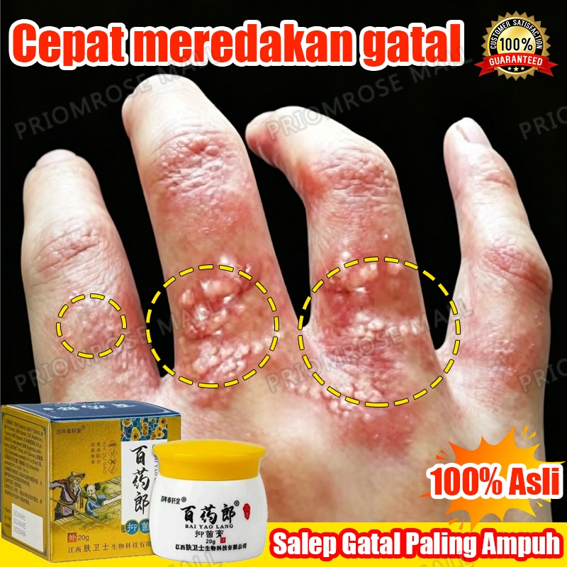 Salep gatal china paling ampuh salep eksim kering dan gatal original obat gatal selangkangan salep g