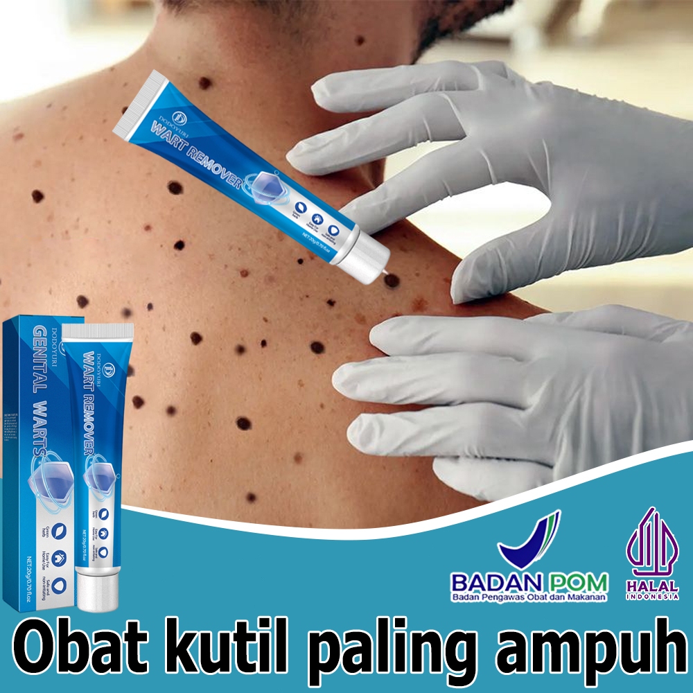 Penghilang kutil dan tahi lalat Penghilang tahi lalat di wajah Obat kutil Obat Penghilang Kutil 100%