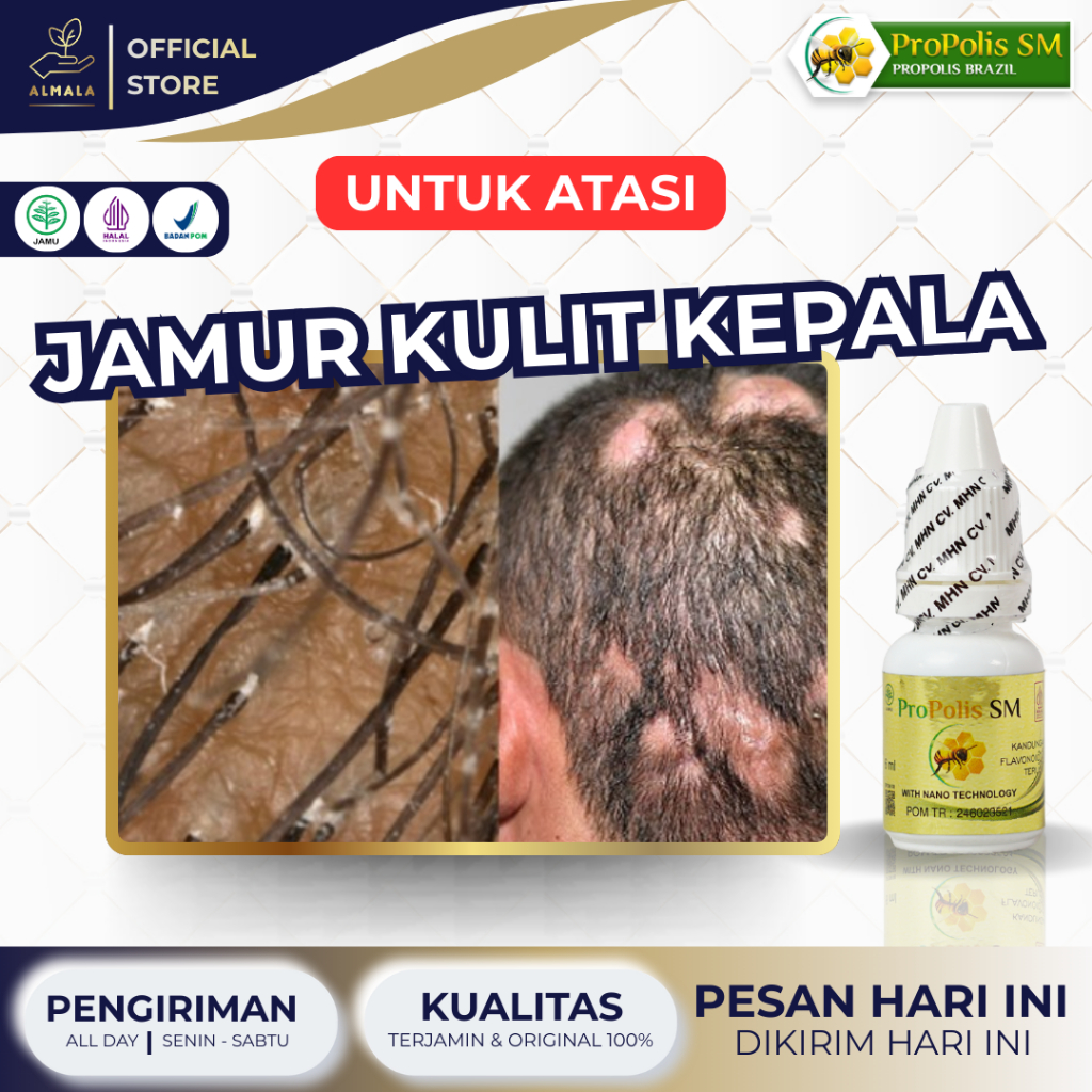 Obat Jamur di kulit Kepala, Obat Kurap Kepala, Obat Psoriasis Kulit Kepala, Obat Kulit Kepala Bersis