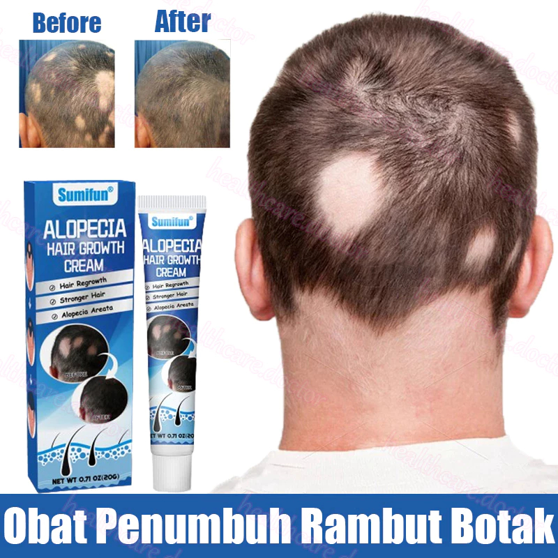 Penumbuh rambut Obat penumbuh rambut Obat Alopecia Areata Rambut Pitak 20g penumbuh rambut serum pen