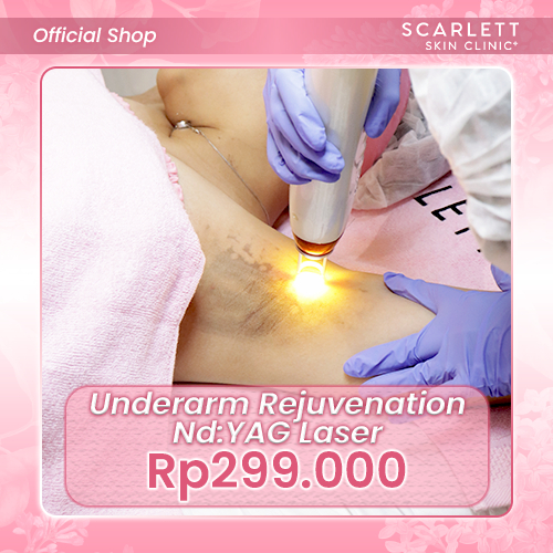 Underarm Rejuvenation NdYAG Laser