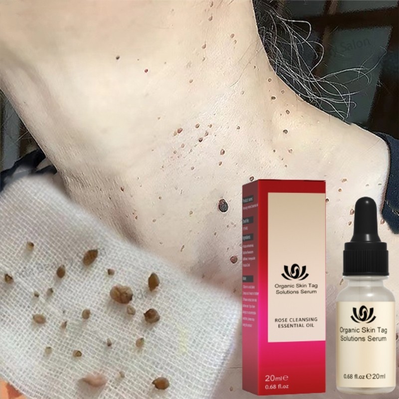 Minyak Esensial Penghilang Tahi Lalat Wajah Menghilangkan Tuntas Bintik Hitam Nevus Alami