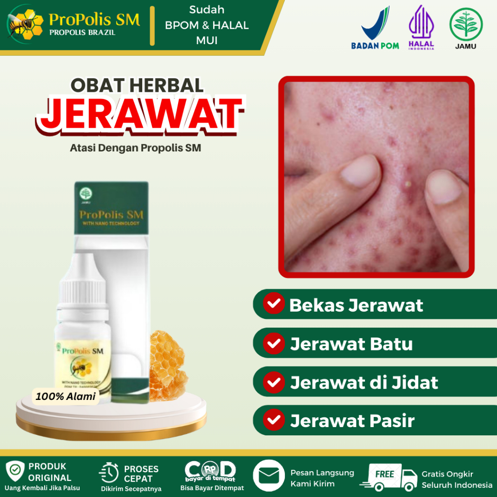 Propolis SM - Obat Oles Jerawat, Bekas Jerawat, Jerawat Batu, Jerawat di Jidat, Jerawat di Pipi, Jer