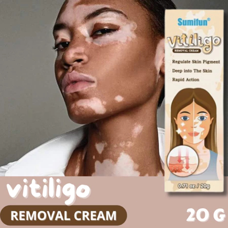 salep bercak putih di wajah Obat Salep Vitiligo 20g Pengobatan Vitiligo Krim Jerawat Keringat Bercak