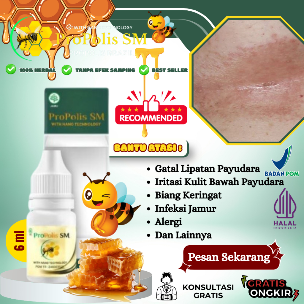 Obat Gatal Lipatan Payudara, Obat Gatal Payudara, Obat Ruam Merah Di Bawah Lipatan Payudara, Obat Ir