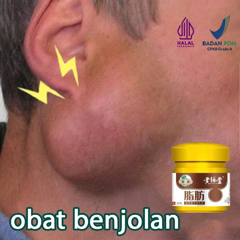 obat benjolan lipoma lipoma cream lipoma salep benjolan ampuh lipoma krim untuk benjolan lipoma sale