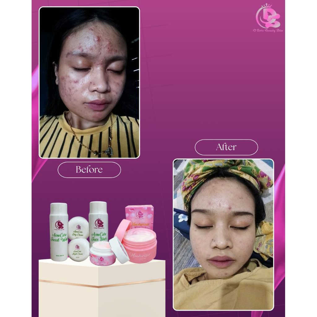PAKET STANDAR ACNE (PAKET SULTAN ACNE, MOISTURIZER, SS SPF 30) DSARS BEAUTY SKIN