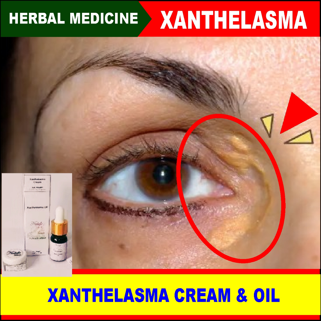 Xanthelasma Cream Penghilang Gumpalan Lemak di Kelopak Mata, Xanthelasma Cream dan Oil, Xanthelasma 