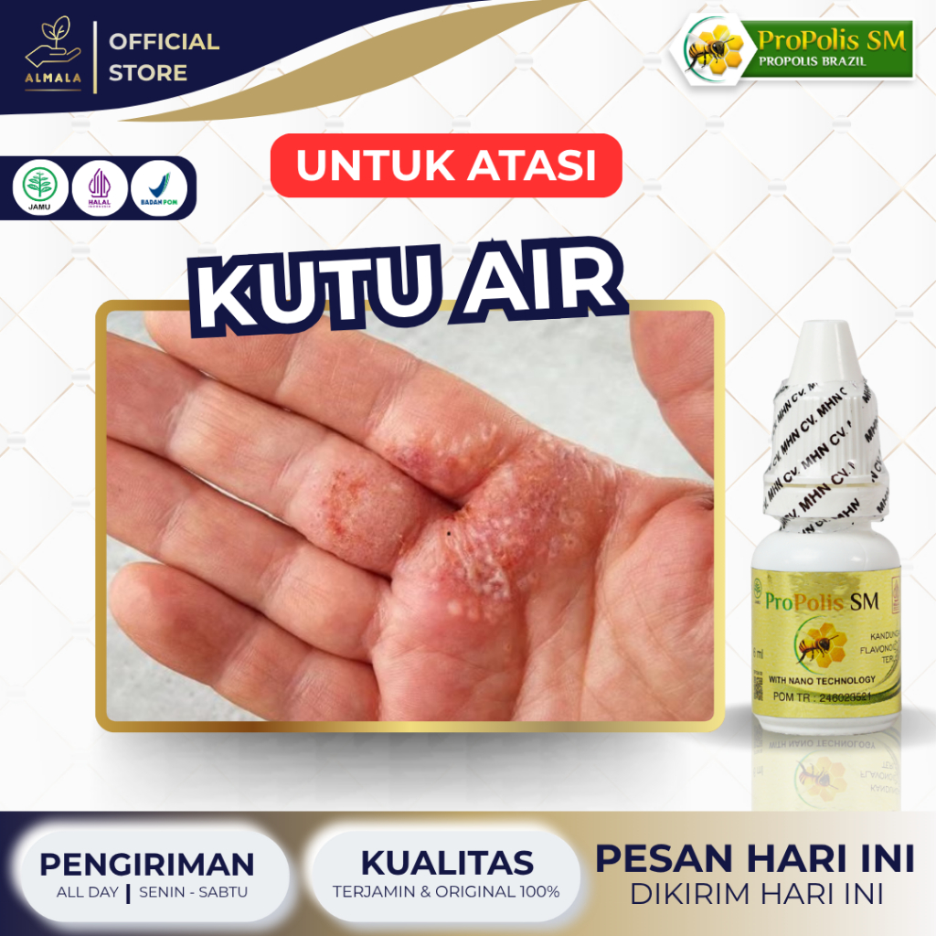 Obat Kutu Air, Penghilang Kuman Air, Gatal Berair, Kutu Air Pada Kaki, Jamur Kaki, Kutu Air Pada Sel