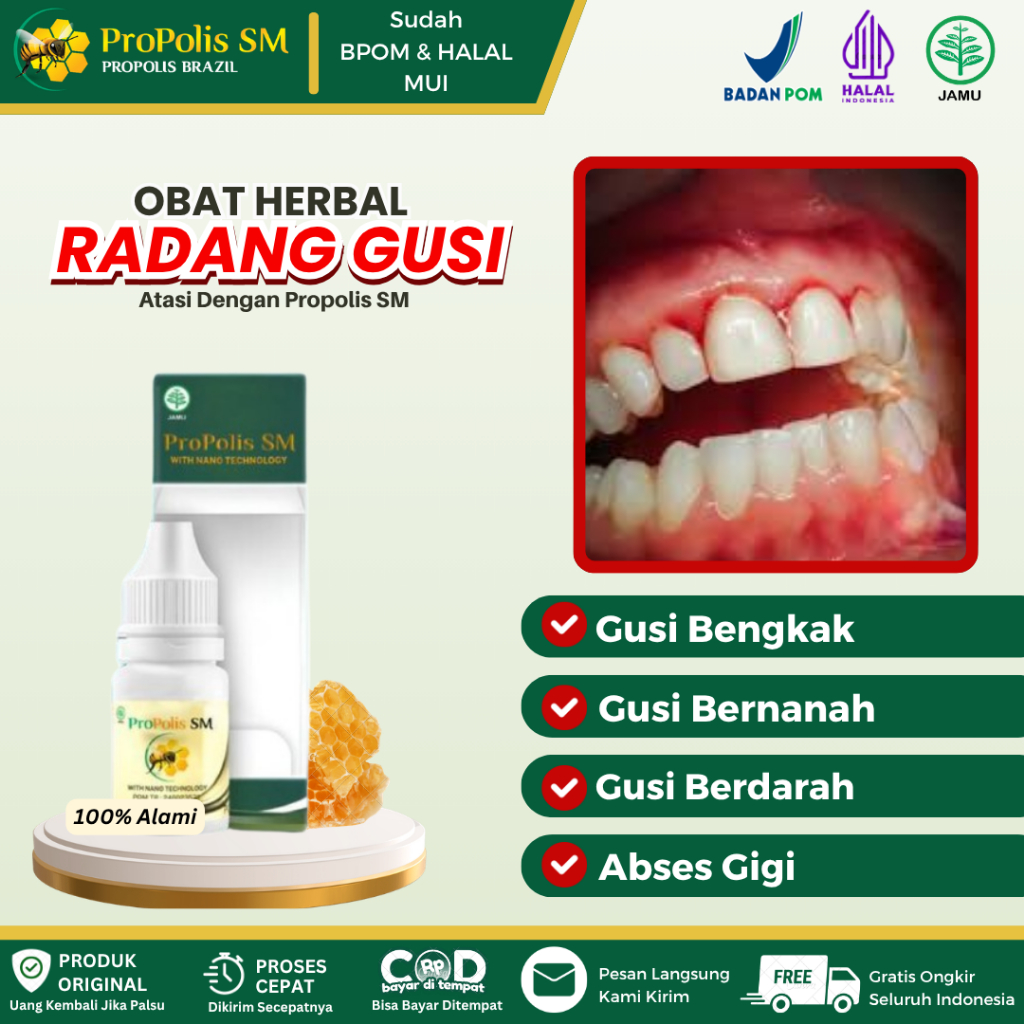 Obat Radang Gusi, Gusi Bengkak, Gusi Turun, Gusi Bernanah, Gusi Sakit, Gusi Berdarah, Abses Gigi, Be