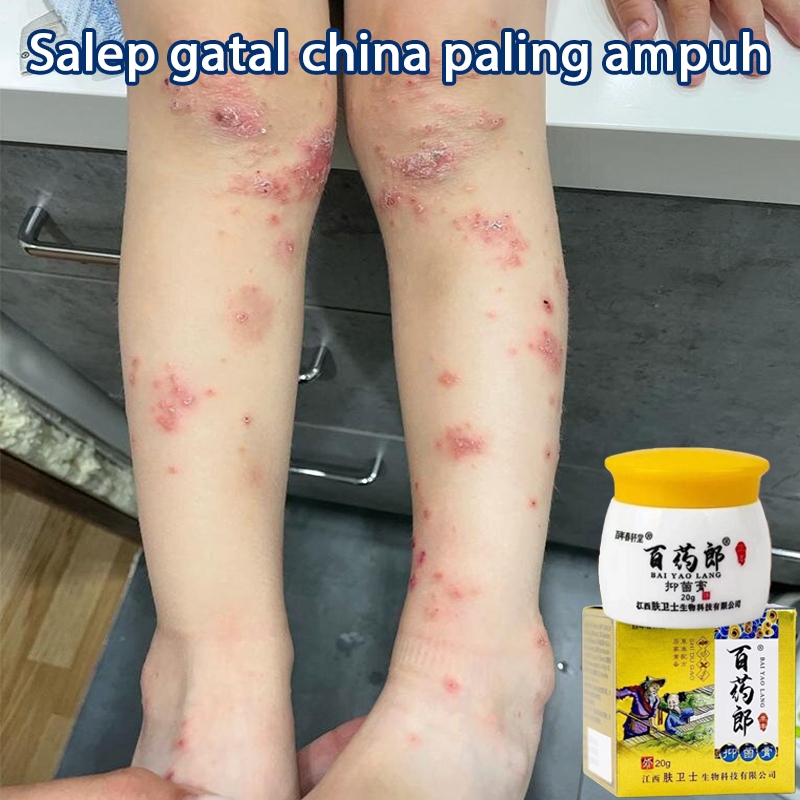 Salep gatal china paling ampuh salep gatal jamur selangkanga Krim Eksim Bayi dan Anak Obat gatal sel