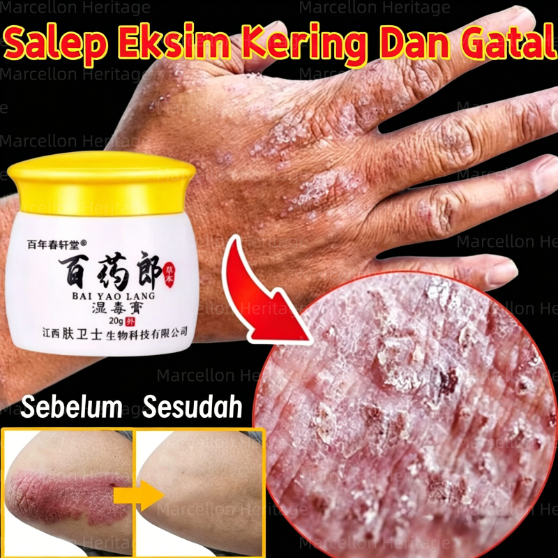Salap gatal china obatgatel alergi kulit gatal salep salep eksim kering dan gatal salep jamur kulit 