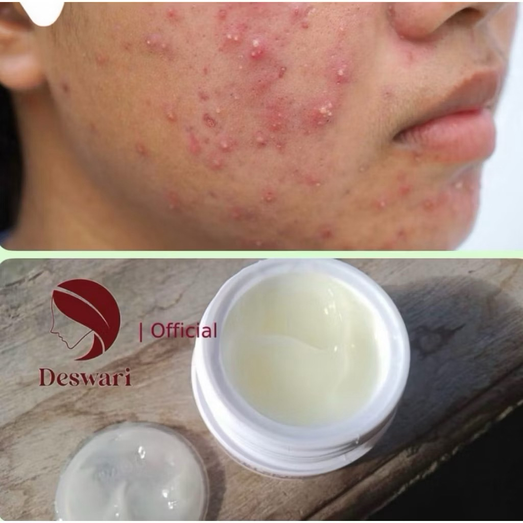 Deswari skincare Night acne cream malam acne jerawat Deswari Skincare