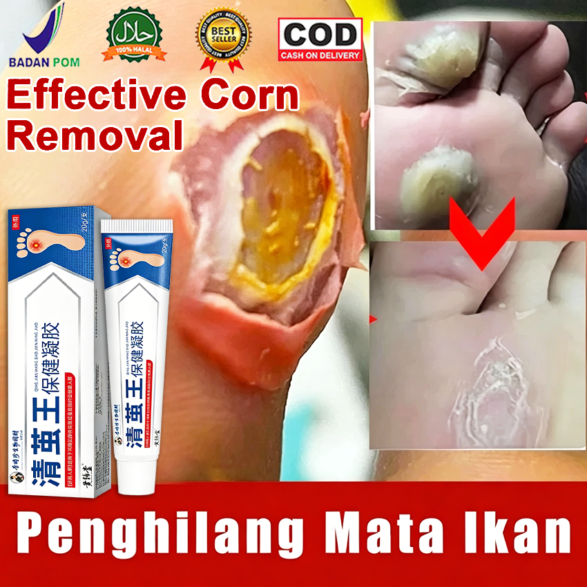 Obat Mata Ikan Obat Kutil Kapalan Mata Ikan Kaki 20g Kaki Ampuh Plester Penghilang Kutil Kapalan Mat