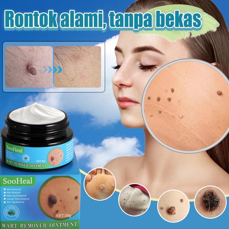 Salep penghilang kutil,Penghilang kutil di leheri,Penghilang kutil di leher,20g,Salep untuk berbagai