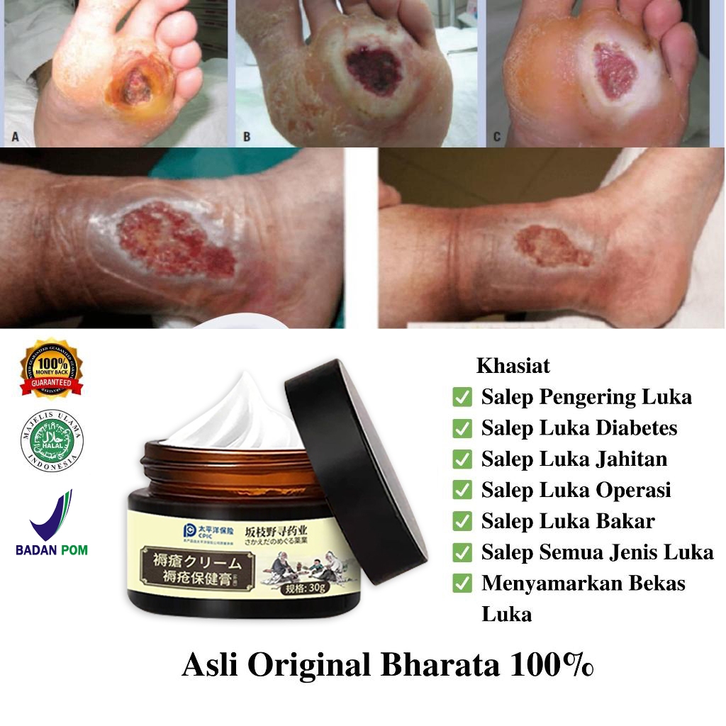 Krim Luka Baring Obat Luka Diabetes, Obat Luka Diabetes Luka Penyembuhan, Salep Luka Cepat Kering 30