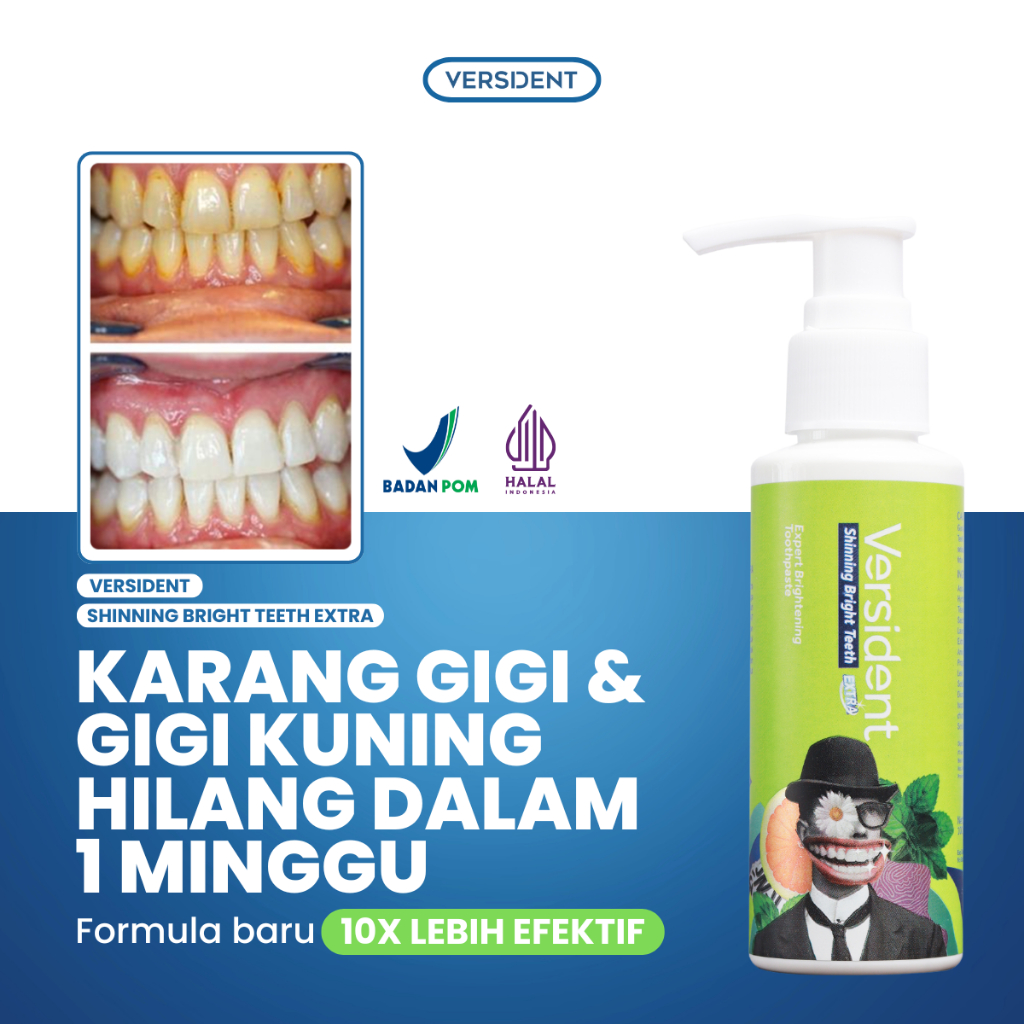 Pasta Gigi Versident Shining Bright Teeth 100g - Memutihkan Gigi, Mencegah Karang, Aroma Segar
