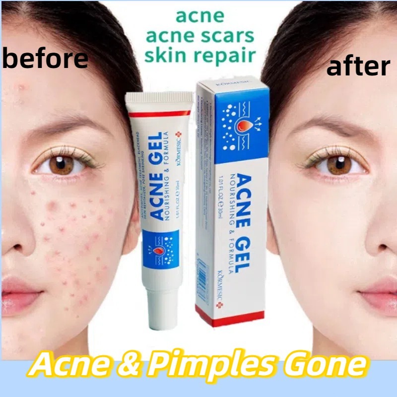 obat jerawat paling ampuh cewek / obat jerawat yang ampuh / obat jerawat / obat jerawat batu paling 