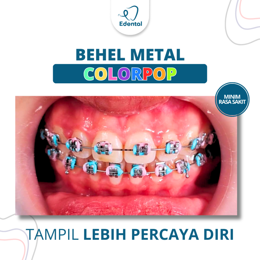 Pasang Behel Metal Colorpop Premium Edental - Kawat Gigi Permanen Konvensional Bracket Logam Aneka P