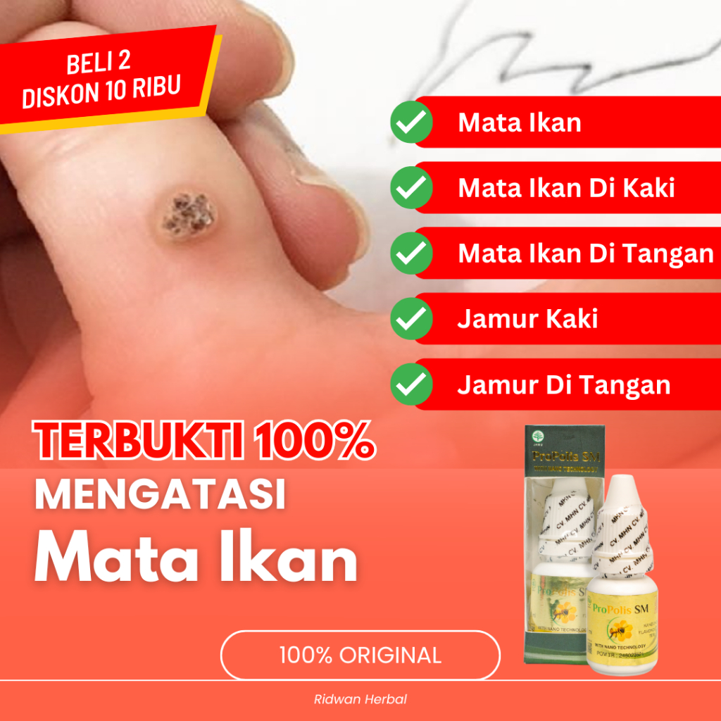 Obat Mata Ikan Pada Telapak Kaki, Obat Penghilang Mata Ikan di Telapak Kaki  Tangan, Obat Mata Ikan 