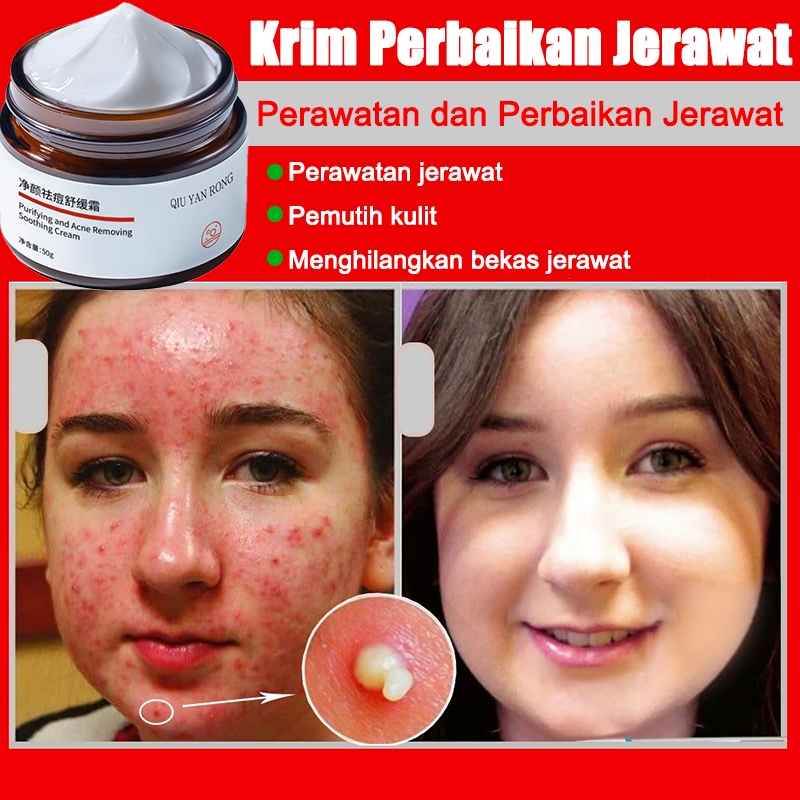 Jerawat Krim jerawat 50g Cream jerawat Penghilang Bopeng Krim mengecilkan pori pori wajah Obat jeraw