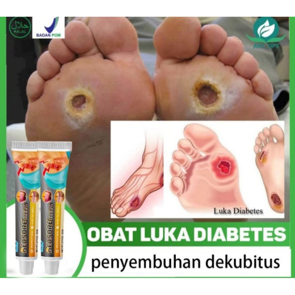 Obat Pengering Luka Basah Bernanah, Salep Luka Borok, Koreng Nanah, Luka Operasi, Caesar, Sesar, Luk