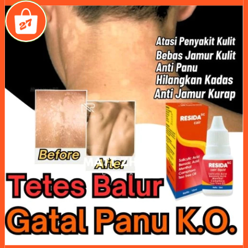 Resida Cair Obat Gatal Kurap Kudis Panu Ampuh 100% /Salep Obat Gatal kurap Kudis Panu Kutu Air Ampuh