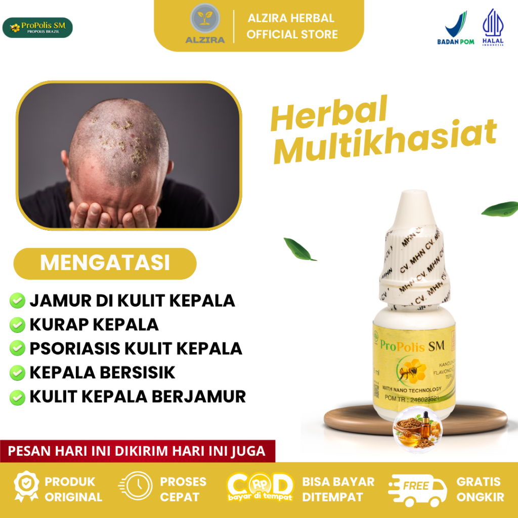 Alzira Herbal - Obat Jamur di kulit Kepala, Obat Kurap Kepala, Obat Psoriasis Kulit Kepala, Obat Kul