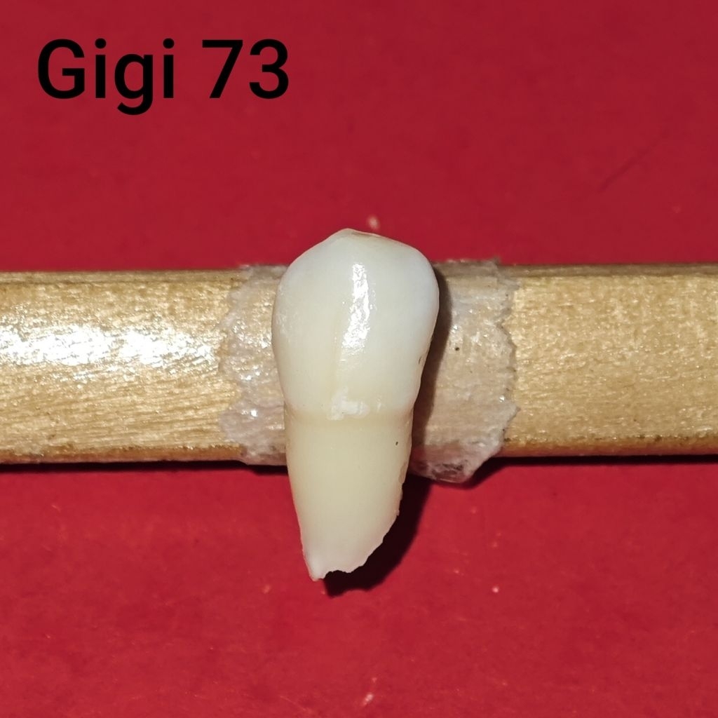 Gigi Susu / Gigi Sulung Kaninus Kiri Anterior Rahang Bawah (Gigi 73) - Gigi Asli - Gigi Praktikum