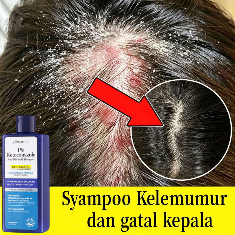 Shampo anti ketombe Kepala Gatal Kulit Psoriasis Penghilang Ketombe Berkerak Dan Gatal Sampo